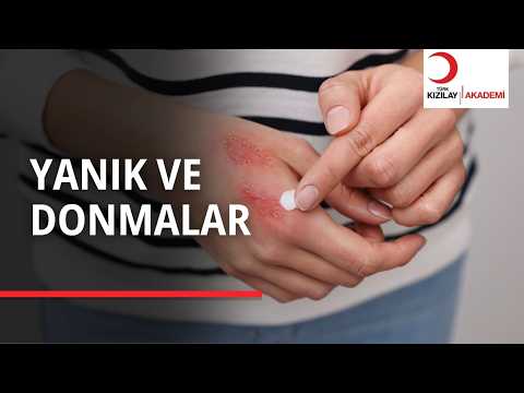 Yanıklarda ve Donmalarda Sakın Bunu Yapmayın!