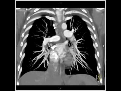 Lung Anatomy: Pulmonary Embolism (VRT)