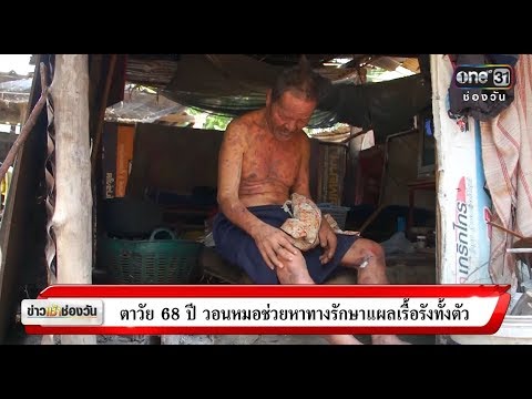การรักษาโซดาของโรคสะเก็ดเงิน Miramistin ไม่กลาก