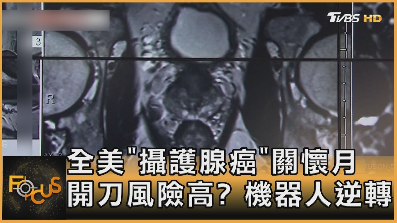 全美「攝護腺癌」關懷月　開刀風險高？機器人逆轉