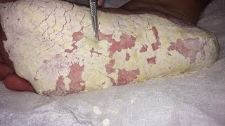 Extreme dry cracked feet skin removal after treatment