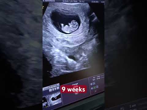 9. Hafta Gebelik: Bebeğinizin Gelişimi