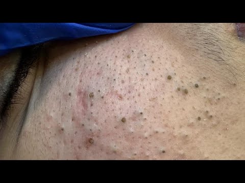 Deep Facial Cleansing Techniques for Acne | Whitehead and Blackhead Solutions