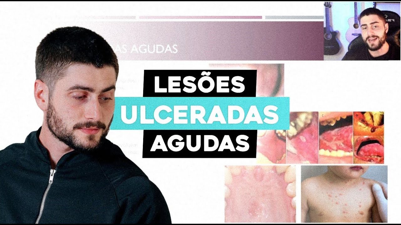 Lesões ulceradas agudas | Estomatologia