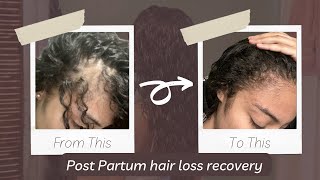 How I RECOVERED from POST PARTUM HAIR LOSS (using only one product!)| Amyla cosmetics