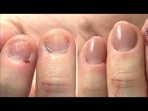 Transformación De Piel y Uñas Cortas Y Mordidas