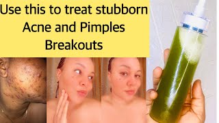 An effective Natural Remedy for Acne and Pimples Breakouts : Achieve a clear skin fast.