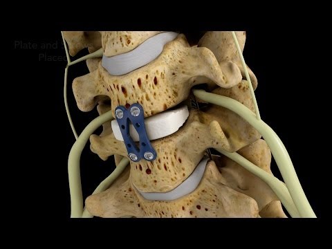 C4-5 Anterior Cervical Diskectomy with Fusion