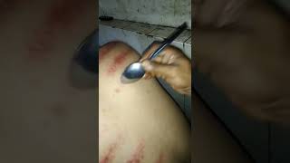 Download lagu kerokan sendok😀😀@teknisi AB mp3