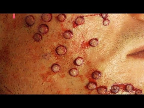 Black Head Face, Trypophobia, Acne?  What is it?  Plus Multivitamin