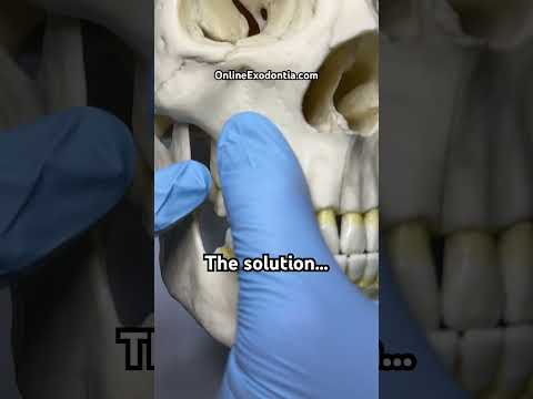 Third Molar Extraction Tip | OnlineExodontia.com | #odontologia #oralsurgery