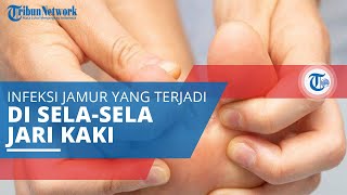 Kutu Air (Tinea Pedis), Infeksi Jamur yang Biasanya Muncul di Sela-sela Jari Kaki
