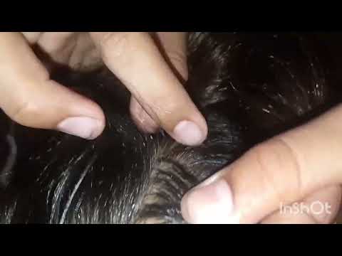 Remove many lice from brown hair - Plucking most of lice from head