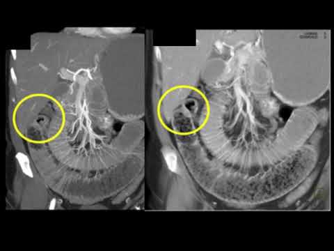 CT Evaluation of Small Bowel Obstruction Part 1