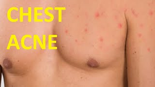 how to get rid of chest acne scars easy overnight