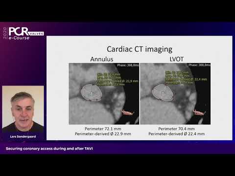 Securing coronary access during and after TAVI - PCR Valves e-Course 2020