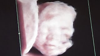 23 Weeks Old Fetus Smiling in mother's Womb - Ultrasound