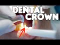 Dental Crown Procedure EXPLAINED