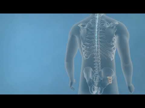 Dr. Georgios Matis - Neuromodulation - 10kHz-High-Frequency Spinal Cord Stimulation