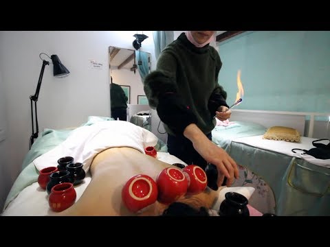 Chinese FIRE CUPPING Therapy
