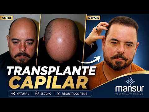 Miniatura do depoimento: Depoimento Real de Transplante Capilar na Clínica