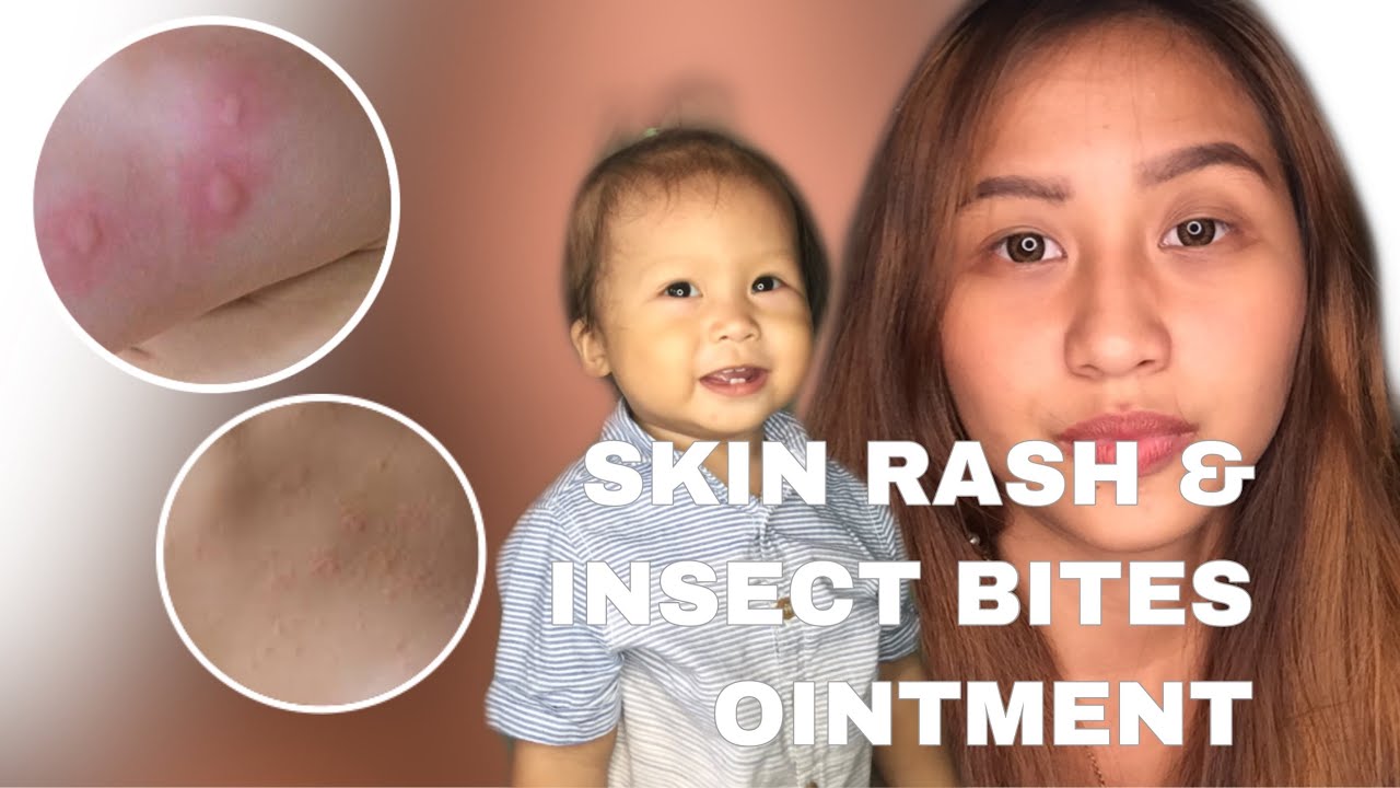 PAANO MAWALA ANG SKIN RASH AT INSECT BITES NI BABY