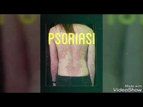 Cura della psoriasi cominciante La dermatite di atopic che il dottore rivolgersi
