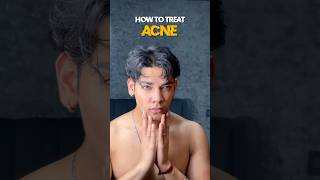 How to treat acne 😍 #acne #pimplefree #skincareroutine