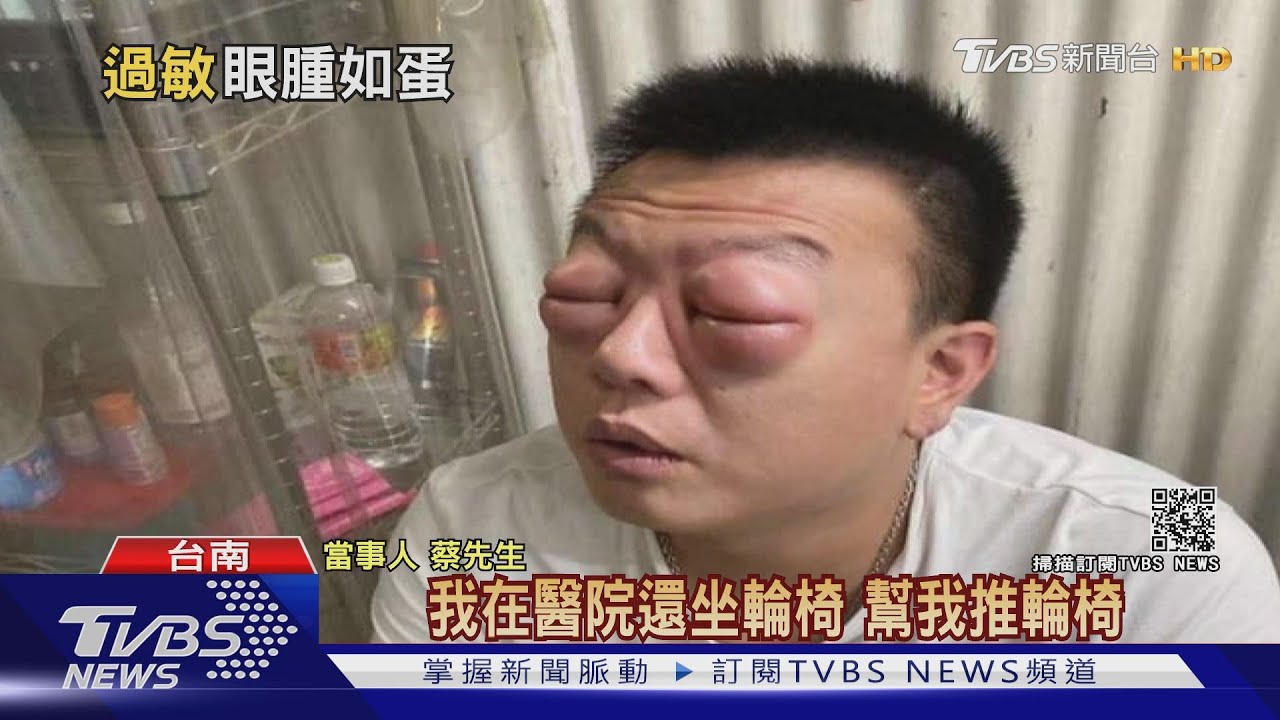 鹹蛋超人是你?!男吃藥過敏雙眼「腫成雞蛋」急就醫