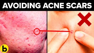 13 Innocent Habits That Will Cause Your Acne To Scar Guaranteed