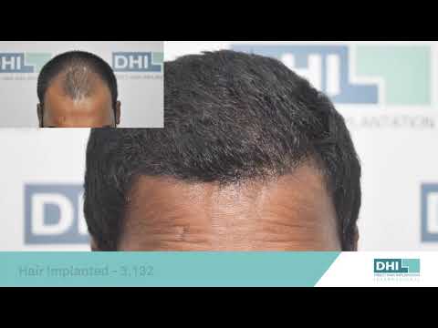 Hair Transplant Result In India Using DHI (Direct Hair Implantation) Technique