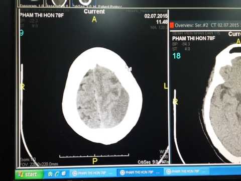 Stroke Case - Large Ischemic Lesion on Brain CT scan