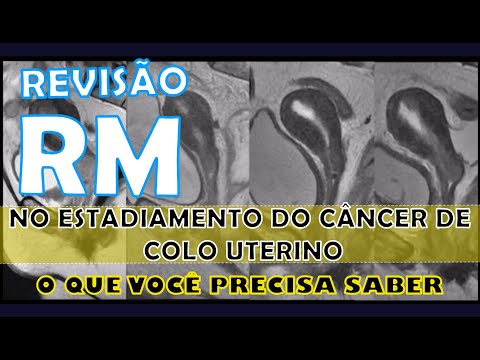 Ressonância magnética no estadiamento do câncer de colo uterino - O que você precisa saber
