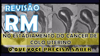 Ressonância magnética no estadiamento do câncer de colo uterino - O que você precisa saber