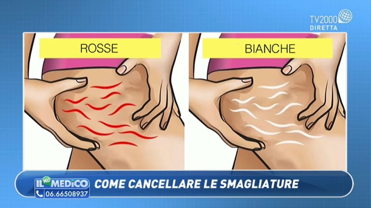 Il Mio Medico - Come cancellare le smagliature