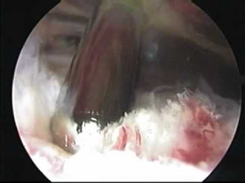 La cintura di fissaggio in osteocondrosi Caviglie calcificazione