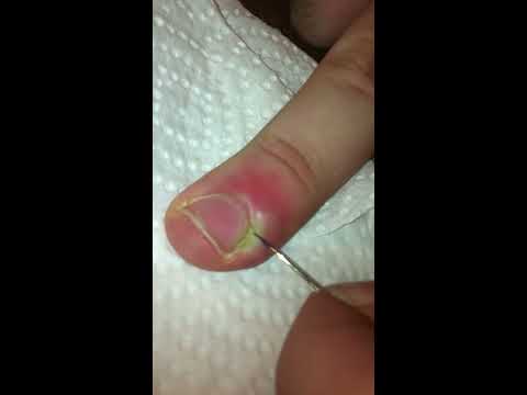 comment guerir ongle incarné