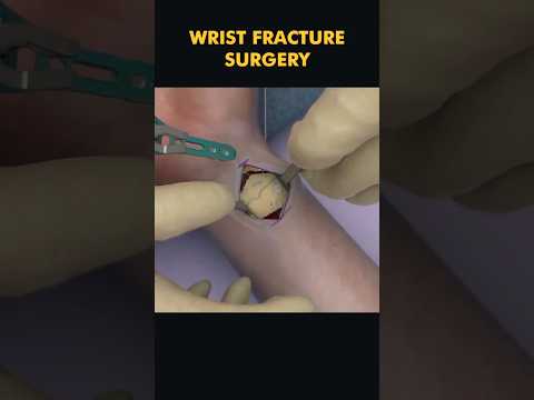 Wrist Fracture Surgery (3d animation) #Medicalworld3d #knowladgeispower #medical #science #hospital