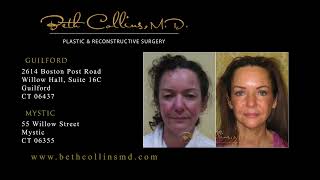 Guilford and Mystic, CT Plastic Surgeon Dr. Beth Collins Shares Some of Her Best Results