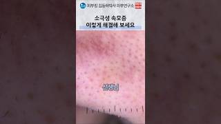 블랙헤드처럼 보이는 피지 속 미세 털 치료
