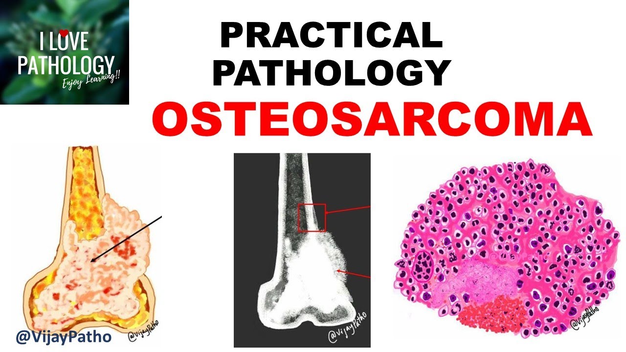 OSTEOSARCOMA: Clinical , Radiological features & Morphology