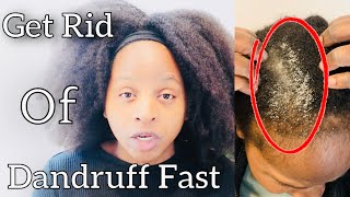 DANDRUFF! How to get rid of Dandruff Fast with Natural Home remedies. Overnight Dandruff Remedies