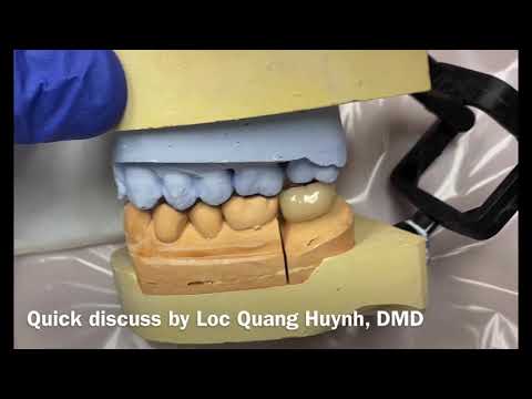 How to prepare, prep, and cement posterior zirconium 3/4 crown, veneer, onlay #crowncementation