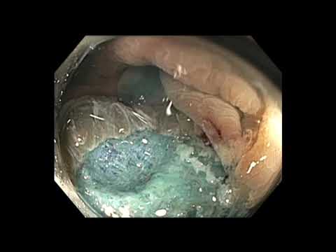 Coloscopie: mucosectomie endoscopique d'un polype du côlon ascendant - accès en montée, coloscopie avec instillation d’eau