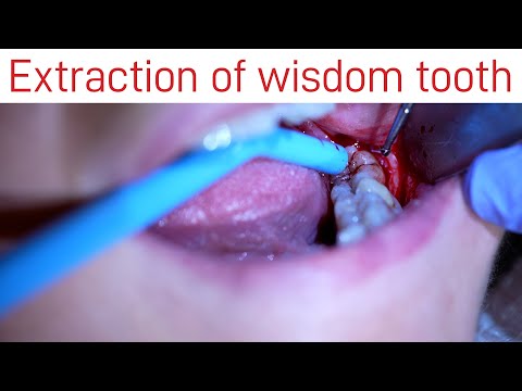 Extraction of Wisdom Tooth
