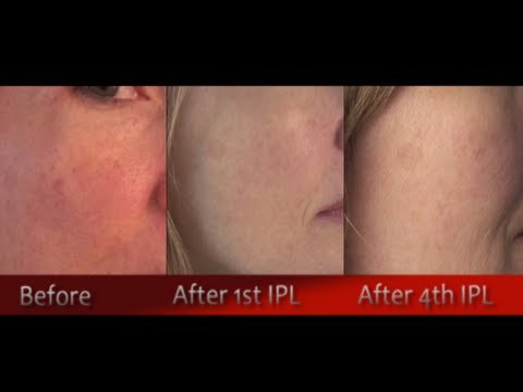 IPL Photofacial Review After 4 Treatments ~ Before & After Video