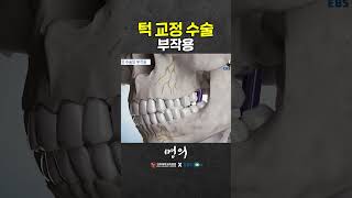 턱 교정 수술 시 생길 수 있는 부작용?