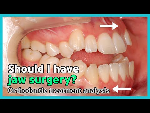 Open bite case accompanied with prognathic mandible.( non-surgical treatment ? )
