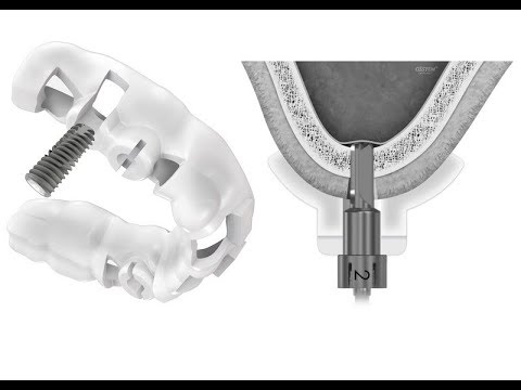 OSSTEM OneCAS Fully Guided Sinus Lift und Implantation