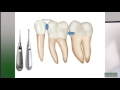 How to make molar extractions easier